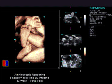 Image: fourSight image enhance with amnioscopic rendering (Photo courtesy of Siemens Healthcare).